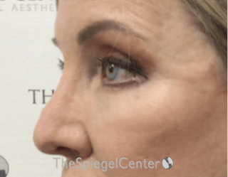 Blepharoplasty Before & After Gallery - Patient 304064 - Image 4