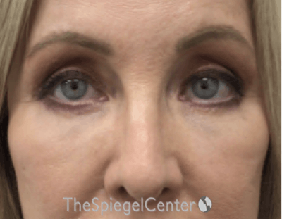 Blepharoplasty Before & After Gallery - Patient 304064 - Image 2