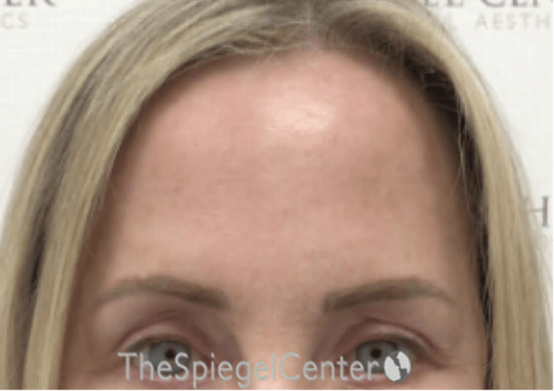Browlift / Fox Eye Lift Before & After Gallery - Patient 158609 - Image 2