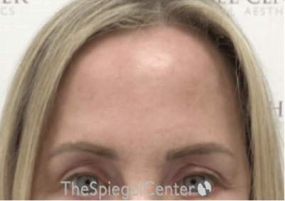 Browlift / Fox Eye Lift Before & After Gallery - Patient 158609 - Image 2