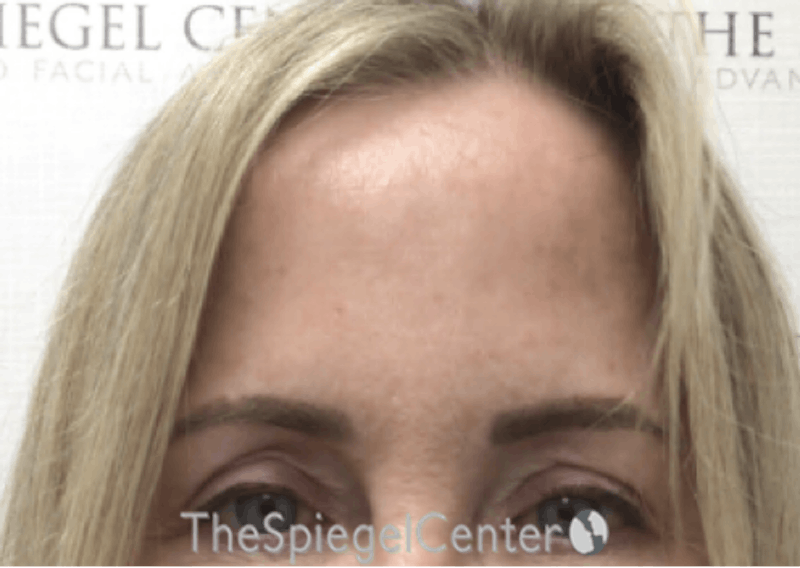 Browlift / Fox Eye Lift Before & After Gallery - Patient 158609 - Image 1