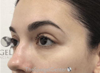 Tear Trough / Under Eye Fillers Before & After Gallery - Patient 194786 - Image 4