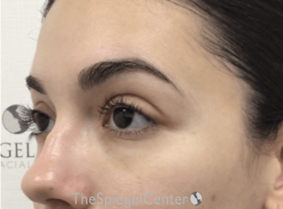 Tear Trough / Under Eye Fillers Before & After Gallery - Patient 194786 - Image 4