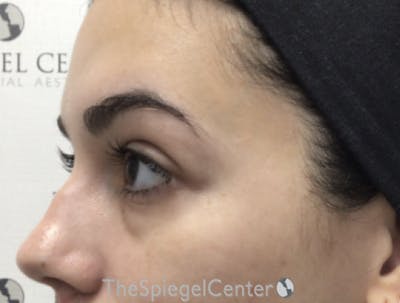 Tear Trough / Under Eye Fillers Before & After Gallery - Patient 194786 - Image 3