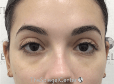 Tear Trough / Under Eye Fillers Before & After Gallery - Patient 194786 - Image 2