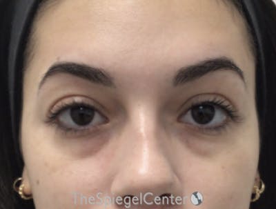 Tear Trough / Under Eye Fillers Before & After Gallery - Patient 194786 - Image 1