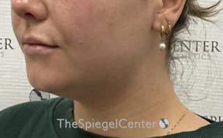 Chin Filler Before & After Gallery - Patient 952311 - Image 4