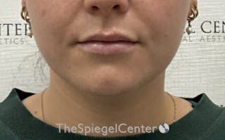 Chin Filler Before & After Gallery - Patient 952311 - Image 2