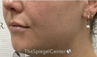 Lip Filler Before & After Gallery - Patient 395869 - Image 6