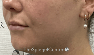 Lip Filler Before & After Gallery - Patient 395869 - Image 6