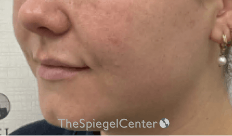 Lip Filler Before & After Gallery - Patient 395869 - Image 5