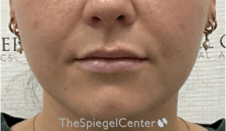 Lip Filler Before & After Gallery - Patient 395869 - Image 4