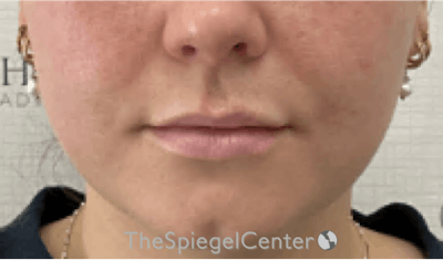 Lip Filler Before & After Gallery - Patient 395869 - Image 3