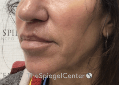 Nasolabial Fold Filler Before & After Gallery - Patient 327151 - Image 4