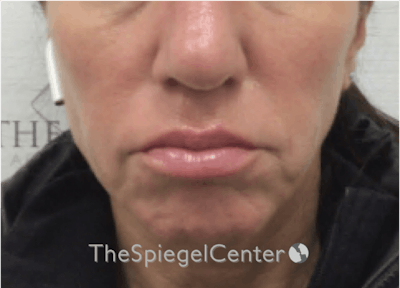 Nasolabial Fold Filler Before & After Gallery - Patient 327151 - Image 1