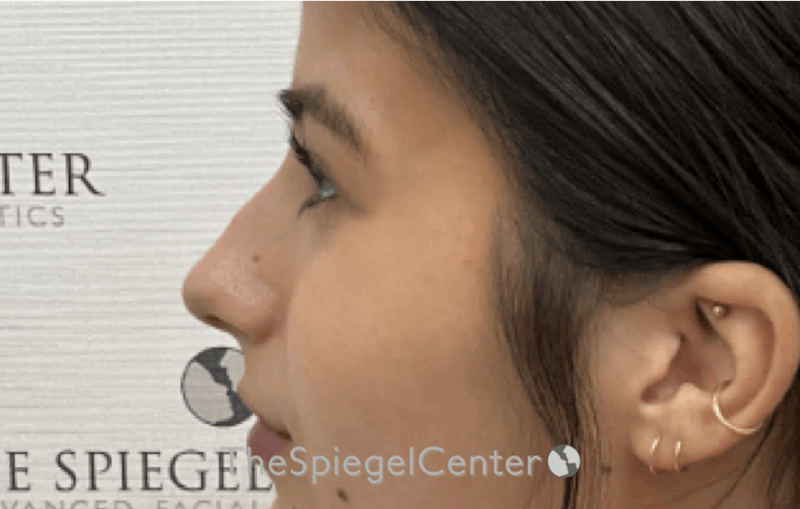 Rhinoplasty Before & After Gallery - Patient 528413 - Image 1