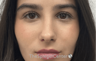 Rhinoplasty Before & After Gallery - Patient 528413 - Image 4