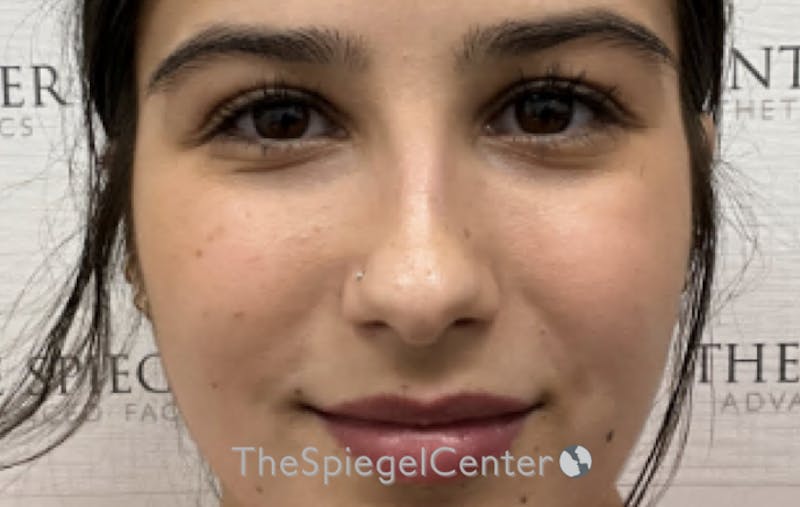 Rhinoplasty Before & After Gallery - Patient 528413 - Image 3