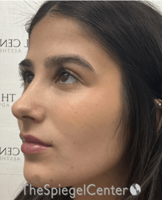 Buccal Fat Reduction Before & After Gallery - Patient 319143 - Image 4