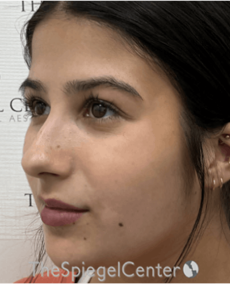 Buccal Fat Reduction Before & After Gallery - Patient 319143 - Image 3