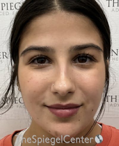 Buccal Fat Reduction Before & After Gallery - Patient 319143 - Image 1