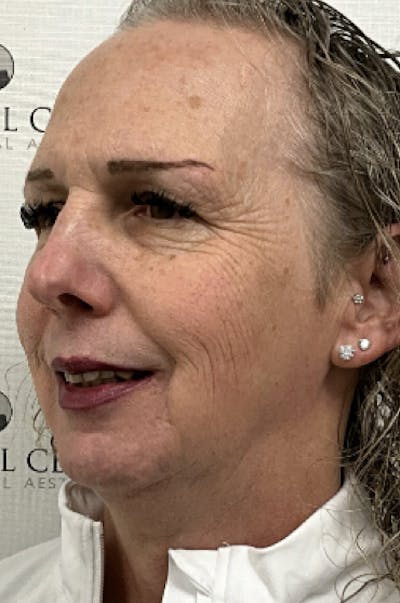 FFS Before & After Gallery - Patient 794382 - Image 3