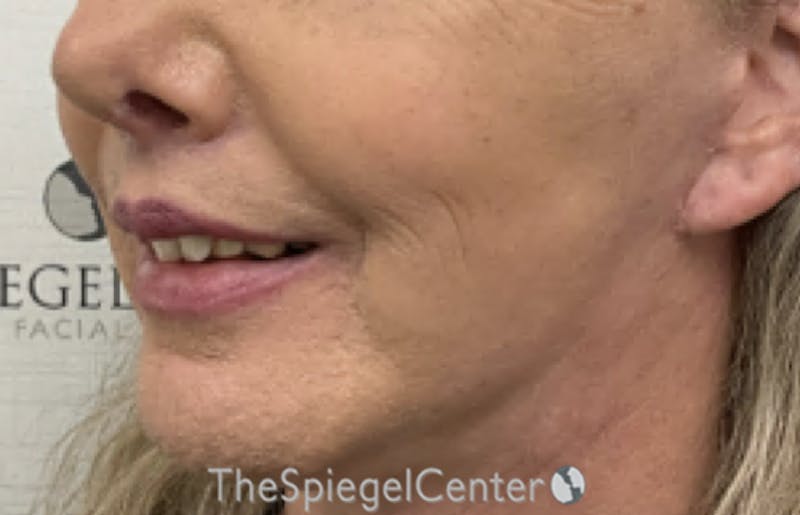 Lip Lift Before & After Gallery - Patient 402352 - Image 4