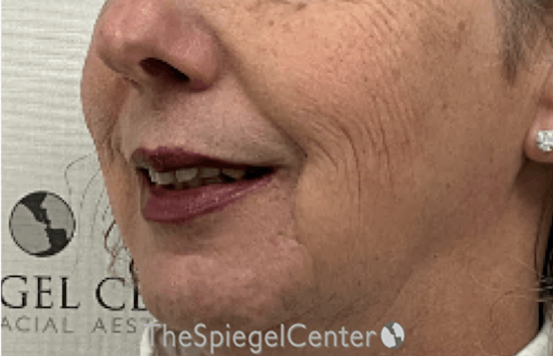 Lip Lift Before & After Gallery - Patient 402352 - Image 3