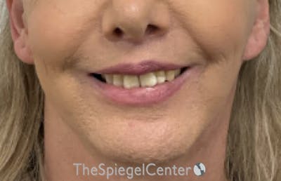 Lip Lift Before & After Gallery - Patient 402352 - Image 2