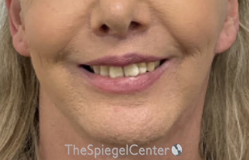 Lip Lift Before & After Gallery - Patient 402352 - Image 2