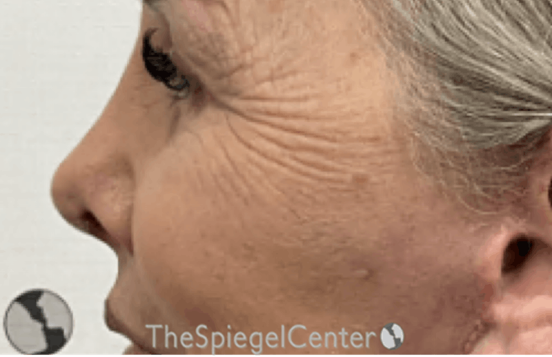 Rhinoplasty Before & After Gallery - Patient 211149 - Image 2
