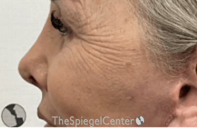 Rhinoplasty Before & After Gallery - Patient 211149 - Image 2