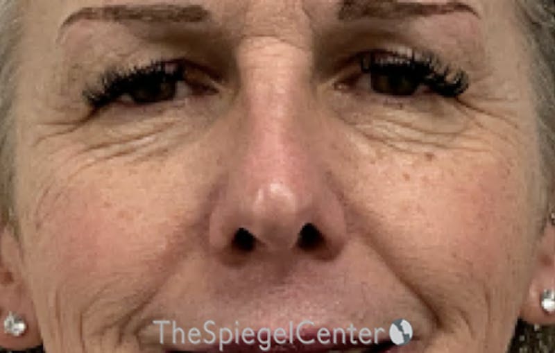 Cheek Implants Before & After Gallery - Patient 154615 - Image 1