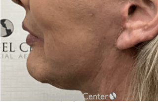 Chin Augmentation Before & After Gallery - Patient 153214 - Image 4