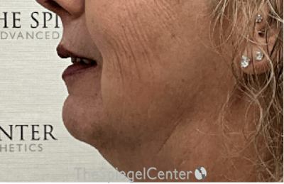 Chin Augmentation Before & After Gallery - Patient 153214 - Image 3