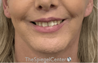 Chin Augmentation Before & After Gallery - Patient 153214 - Image 2