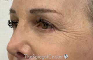 Blepharoplasty Before & After Gallery - Patient 351207 - Image 4