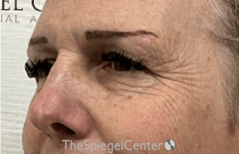 Blepharoplasty Before & After Gallery - Patient 351207 - Image 3