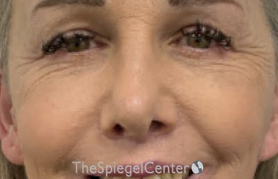 Blepharoplasty Before & After Gallery - Patient 351207 - Image 2