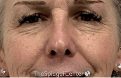 Blepharoplasty Before & After Gallery - Patient 351207 - Image 1
