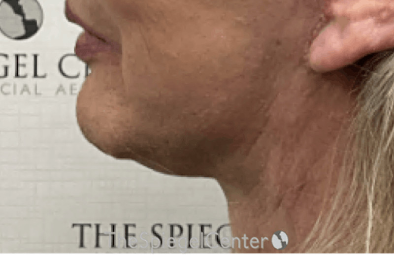 Neck Lift Before & After Gallery - Patient 103723 - Image 2