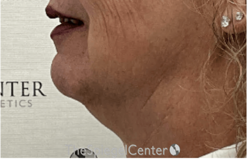 Neck Lift Before & After Gallery - Patient 103723 - Image 1