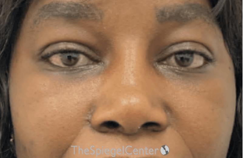 Rhinoplasty Before & After Gallery - Patient 219271 - Image 4