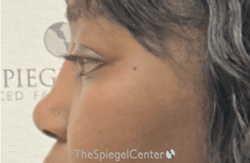 Rhinoplasty Before & After Gallery - Patient 219271 - Image 2