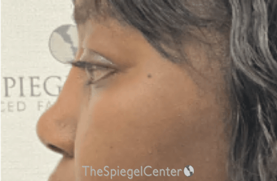 Rhinoplasty Before & After Gallery - Patient 219271 - Image 2