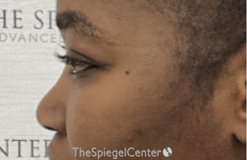Rhinoplasty Before & After Gallery - Patient 219271 - Image 1
