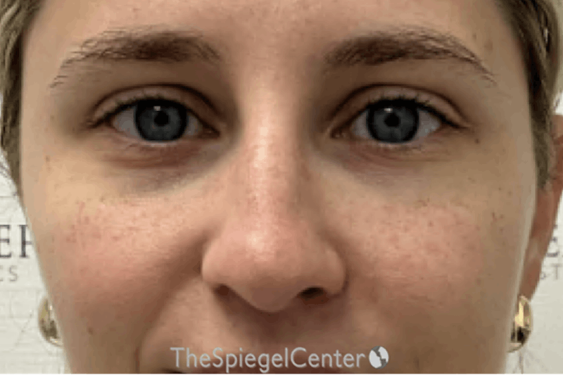 Non-Surgical Rhinoplasty / Nose Filler Before & After Gallery - Patient 831574 - Image 2