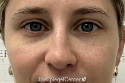 Non-Surgical Rhinoplasty / Nose Filler Before & After Gallery - Patient 831574 - Image 2