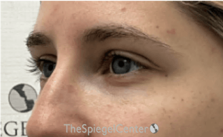 Tear Trough / Under Eye Fillers Before & After Gallery - Patient 202211 - Image 4