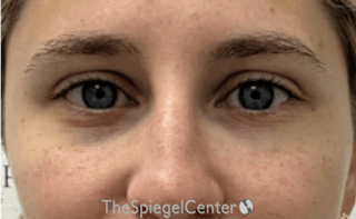 Tear Trough / Under Eye Fillers Before & After Gallery - Patient 202211 - Image 2